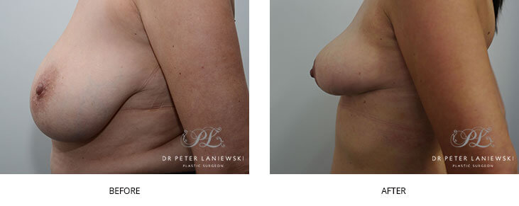 Breast reduction before and after - image 001, side view