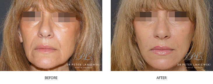 Facelift before and after, photo 01, Dr Laniewski Sydney & Central Coast