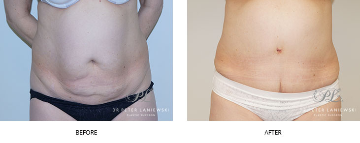 A patient before and after abdominoplasty with Dr Laniewski, photo 11