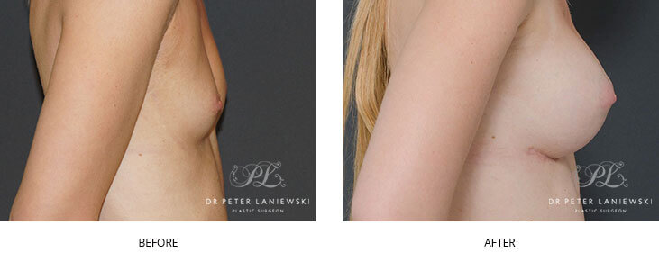 breast implants sydney - before and after - image 011