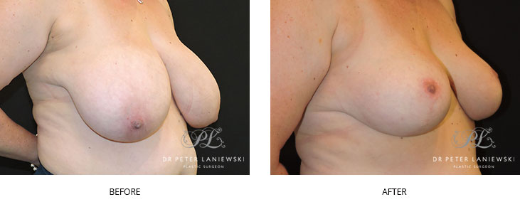 Breast reduction patient before and after surgery - image 002, angle view
