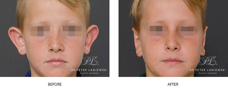 otoplasty in children - before and after - image 08