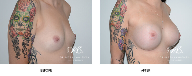 Sydney breast augmentation surgery with implants, before and after 28, Dr Peter Laniewski