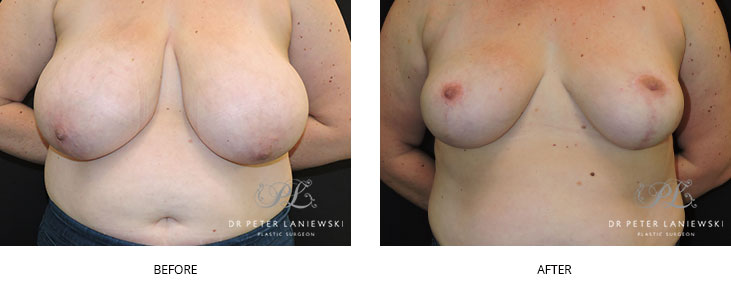 breast reduction before and after - image 003, front