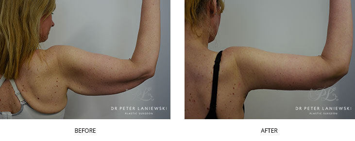 Arm lift plastic surgery, before and after photo 04, Dr Laniewski