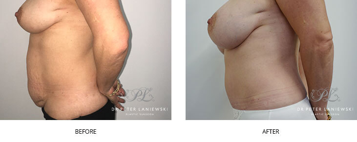 Tummy tuck, photo 08, Dr Laniewski, before & after