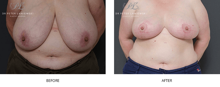 breast reduction before and after 01