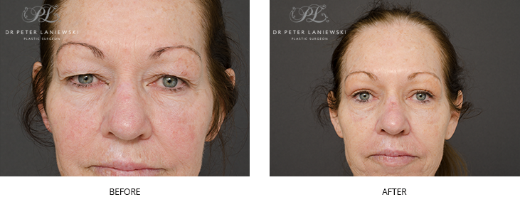 Eyelid surgery patient, photo 14, before and after surgery