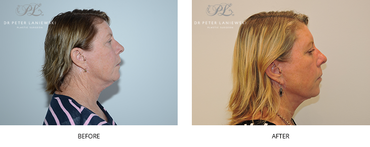 Facelift surgery before and after photo, patient 05, female, side view