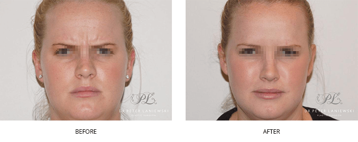 Wrinkle relaxers before and after, photo 01, Dr Laniewski Sydney & Central Coast