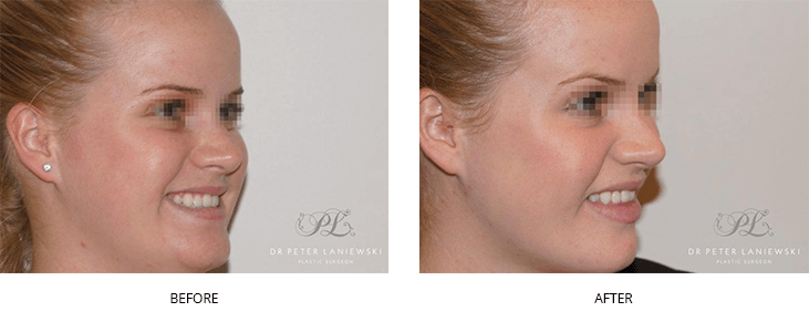 Anti-wrinkle injections 02, before and gallery, Dr Laniewski Sydney