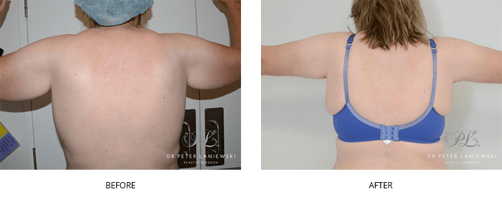 Arm lift before and after in Sydney, photo 01, Dr Laniewski