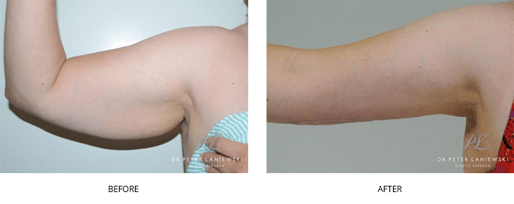Arm lift photo 02, right hand before & after, front view