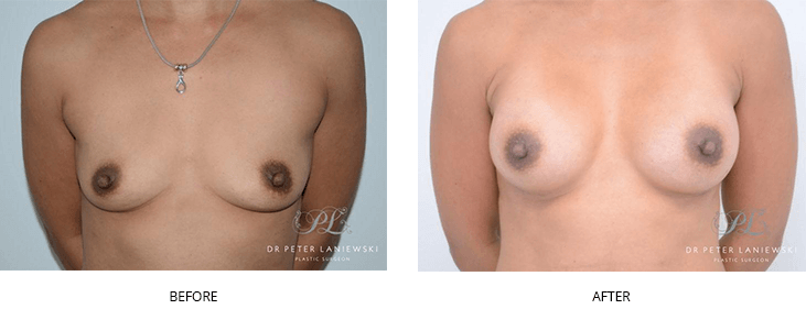 Breast augmentation with implants patient before and after 01, front view