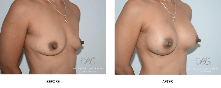 Breast augmentation surgery in Sydney, before and after 02, Dr Laniewski