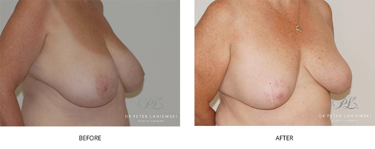 breast reduction patient - before and after images - 45 degree view