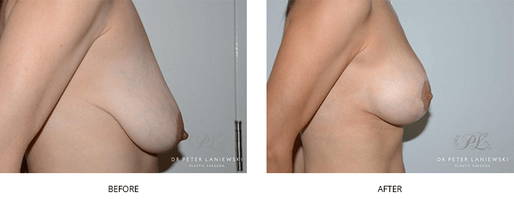 mammaplasty surgery - breast reduction before & afters - patient 02, side view