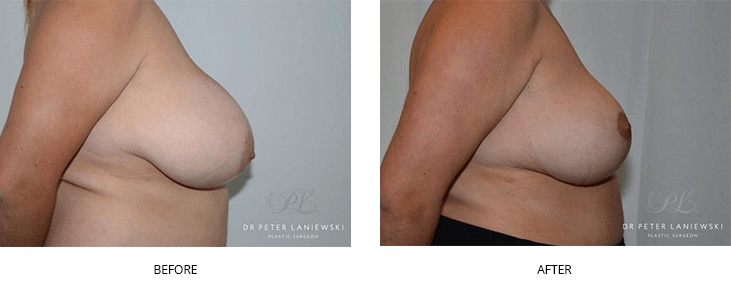 reduction mammaplasty - before & afters - patient 03, side view