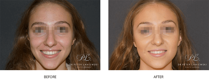 Before and after nose reshaping with fillers, photo 02, young female, front view