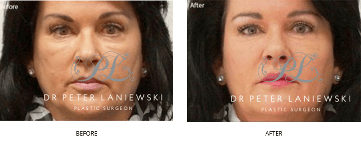 Dermal fillers patient, photo 03, before & after