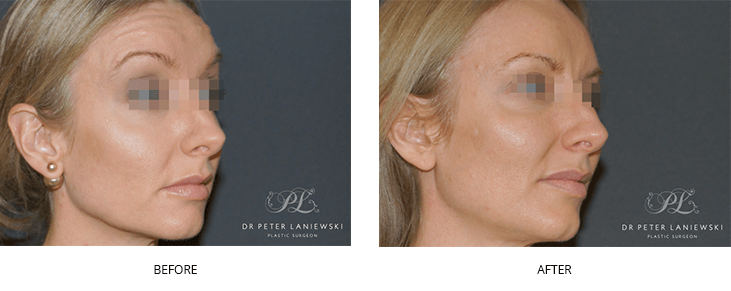 Dermal fillers before and after 04, side view