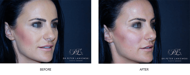Before and after dermal fillers, photo 05, side view