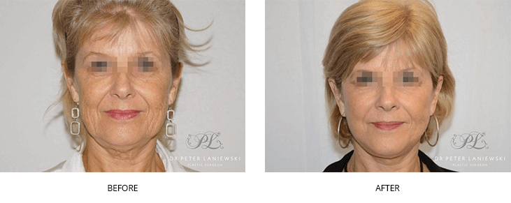 Facelift & neck lift before and after, photo 04, front view