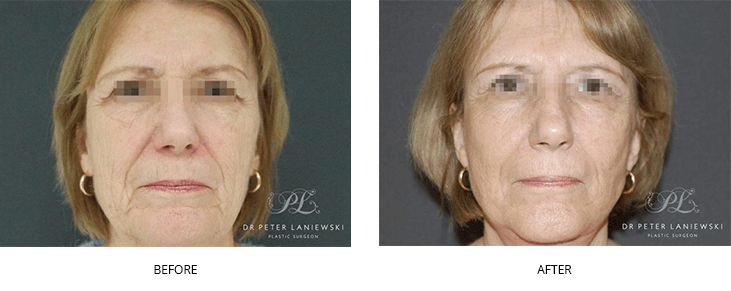 Facelift and neck lift, before and after photo 02, front view