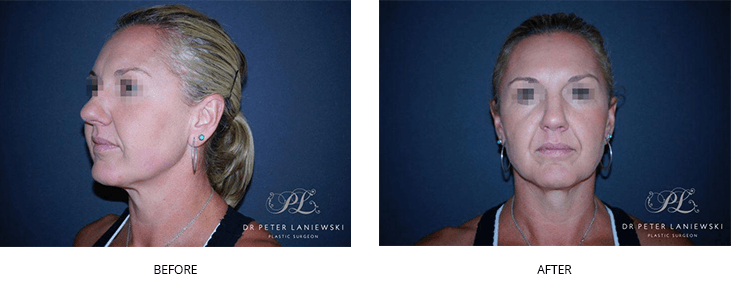 Facial fat transfer photo 03, before & after gallery, patient 01