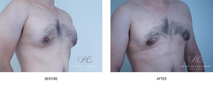 before and after male breast reduction - image 04
