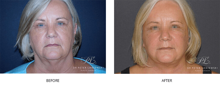 Nose job before and after, photo 03, female, front view