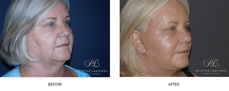 Rhinoplasty before and after, photo 01, side view, female