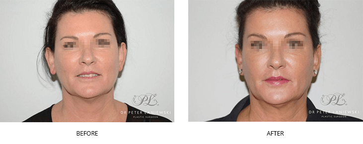 Otoplasty photos, before and afters 01, female patient