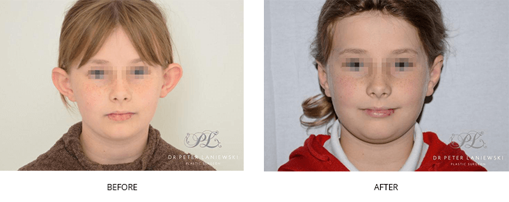 Cosmetic ear surgery gallery, before and after photos 04, child image