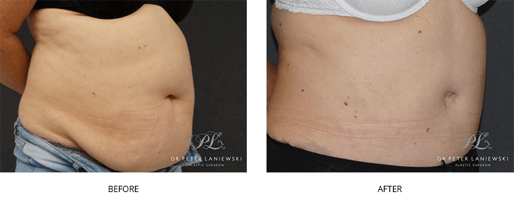Abdominoplasty surgery, before and after gallery, photo 02