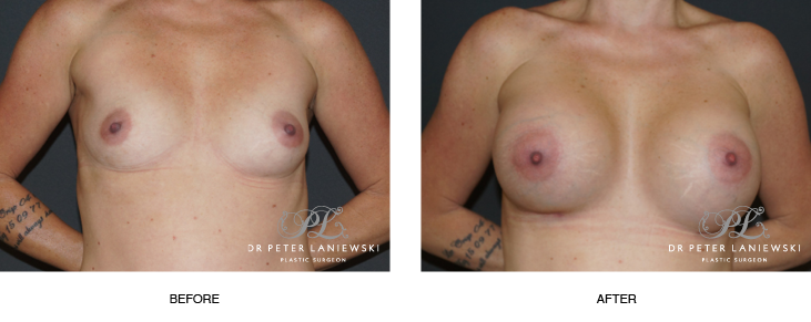 Breast enlargement before and after, photo 01
