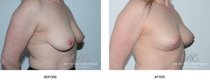 Breast lift (Mastopexy surgery) before and after 02, Dr Laniewski Sydney