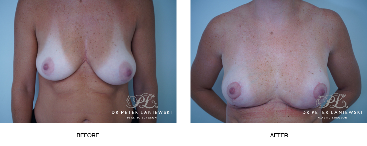 Breast asymmetry surgery, before and after photo 04, front view