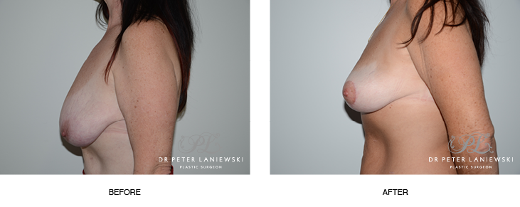 Breast lift patient before and after, photo 06, side view