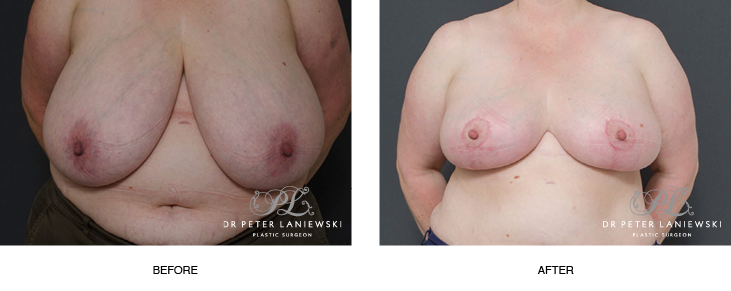 Breast reduction surgery photos, before and after, patient 01, front view