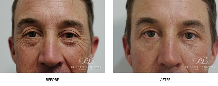 Blepharoplasty before and after, photo 01
