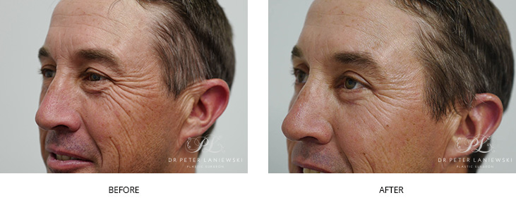 Blepharoplasty before and after, photo 02