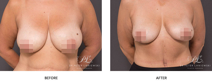 Patient before and after mastopexy surgery, photo 01, front view