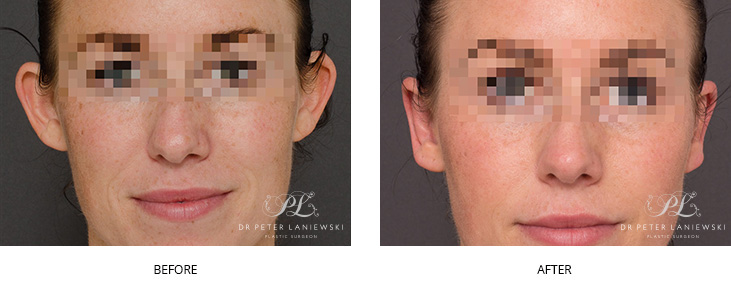 Otoplasty before and after, photo 01, front, Dr Laniewski