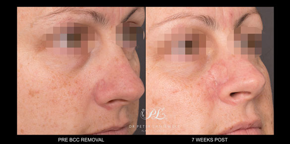 skin cancer surgery before and after - image 001 bcc removal