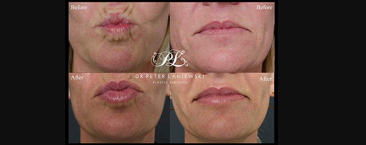 Lip fillers before and after, photo 03