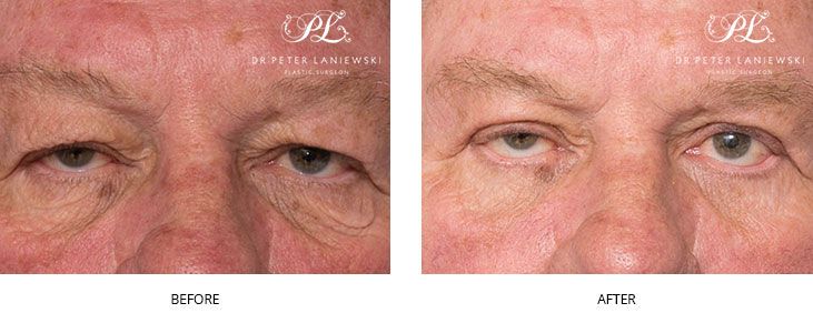 Eyelid surgery before and after, photo 13, male patient, front view