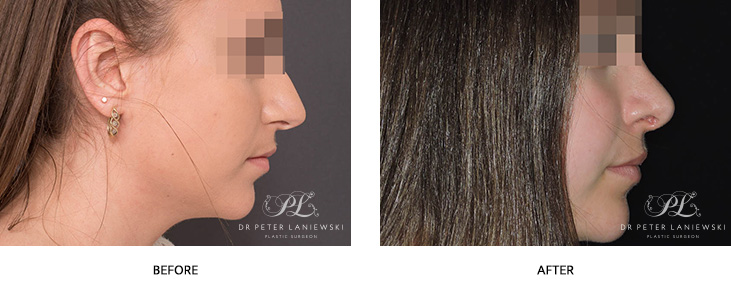 Rhinoplasty before and after (nose job), photo 05, side view