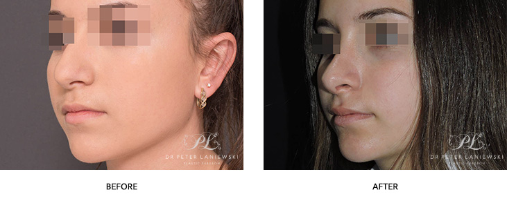 Rhinoplasty before and after, photo 04 angle