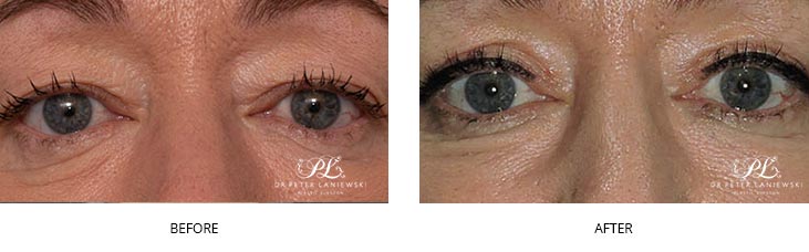 before and after eyelid surgery - real patient - closeup image 09